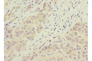 Immunohistochemistry of paraffin-embedded human liver cancer using ABIN7165663 at dilution of 1:100 (PHF17 antibody  (AA 543-842))