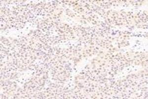 Immunohistochemistry analysis of paraffin-embedded human liver cancer using SRFBP1 (ABIN7075579) at dilution of 1: 2000 (SRFBP1 antibody)