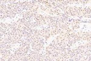 Immunohistochemistry analysis of paraffin-embedded human liver cancer using SRFBP1 (ABIN7075579) at dilution of 1: 2000 (SRFBP1 antibody)