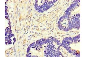 Immunohistochemistry of paraffin-embedded human ovarian cancer using ABIN7149154 at dilution of 1:100 (COX1 antibody  (AA 474-513))