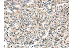 The image on the left is immunohistochemistry of paraffin-embedded Human liver cancer tissue using ABIN7128031(THAP2 Antibody) at dilution 1/20, on the right is treated with fusion protein. (THAP2 antibody)