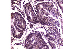 IHC analysis of BRG1 using anti-BRG1 antibody . (SMARCA4 antibody  (AA 555-763))