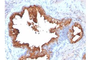 Formalin-fixed, paraffin-embedded human Prostate Carcinoma stained with PSA Rabbit Recombinant Monoclonal Antibody (KLK3/2871R). (Recombinant Prostate Specific Antigen antibody)