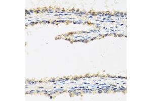 Immunohistochemistry of paraffin-embedded human prostate using SPINT1 antibody (ABIN5973812) at dilution of 1/100 (40x lens). (SPINT1 antibody)