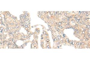Immunohistochemistry of paraffin-embedded Human liver cancer tissue using DCP2 Polyclonal Antibody at dilution of 1:45(x200) (DCP2 antibody)