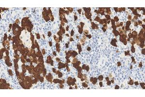 Anaplastic large cell lymphoma: immunohistochemical staining for ALK. (P80 (C-Term), (Catalytic Domain) antibody)
