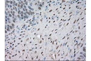 Immunohistochemical staining of paraffin-embedded Adenocarcinoma of colon tissue using anti-NAT8mouse monoclonal antibody.