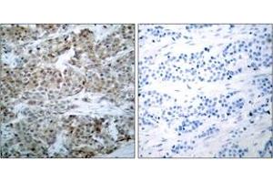 Immunohistochemistry analysis of paraffin-embedded human breast carcinoma, using BAD (Phospho-Ser112) Antibody. (BAD antibody  (pSer75))