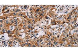 Immunohistochemistry of paraffin-embedded Human lung cancer using MMP1 Polyclonal Antibody at dilution of 1:60 (MMP1 antibody)