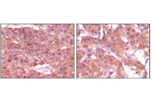 Immunohistochemical analysis of paraffin-embedded human skin carcinoma (left) and breast carcinoma (right), showing cytoplasmic and membrane localization using SRA mouse mAb with DAB staining. (SRA1 antibody)