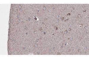 ABIN6276691 at 1/100 staining Human brain cancer tissue by IHC-P. (TLR8 antibody  (C-Term))