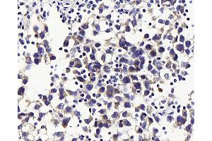 Immunohistochemistry analysis of paraffin-embedded human testis cancer using GLUT-3 Polyclonal Antibody at dilution of 1:300. (SLC2A3 antibody)