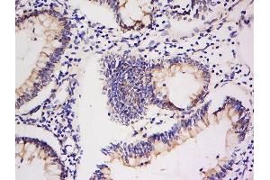 Formalin-fixed and paraffin embedded human colon carcinoma labeled with Anti-Integrin Alpha V + Beta 5 Polyclonal Antibody, Unconjugated  at 1:200 followed by conjugation to the secondary antibody and DAB staining. (ITGAV/ITGB5 antibody)