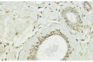 Immunohistochemistry of paraffin-embedded Human breast using Snail Polyclonal Antibody at dilution of 1:100 (40x lens). (SNAIL antibody)