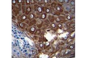 MMP1 antibody immunohistochemistry analysis in formalin fixed and paraffin embedded human esophageal carcinoma (MMP1 antibody  (AA 317-347))
