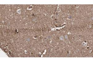 ABIN6279280 at 1/100 staining Human brain cancer tissue by IHC-P. (CSPP1 antibody  (C-Term))