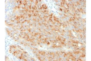 Formalin-fixed, paraffin-embedded human Pancreatic Carcinoma stained with Synaptophysin-Monospecific Mouse Monoclonal Antibody (SYP/3551).