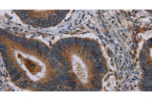 Immunohistochemistry of paraffin-embedded Human colon cancer using MAP3K11 Polyclonal Antibody at dilution of 1:40 (MAP3K11 antibody)