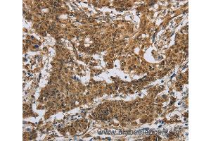 Immunohistochemistry of Human gastric cancer using IL5RA Polyclonal Antibody at dilution of 1:40