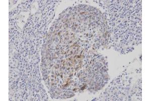 IHC-P Image Immunohistochemical analysis of paraffin-embedded human gastric cancer, using CLCA1, antibody at 1:100 dilution. (CLCA1 antibody)