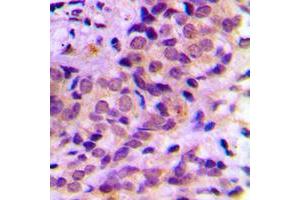 Immunohistochemical analysis of AKT staining in human prostate cancer formalin fixed paraffin embedded tissue section.