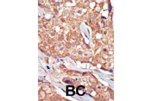 Formalin-fixed and paraffin-embedded human cancer tissue reacted with TRPM6 polyclonal antibody  , which was peroxidase-conjugated to the secondary antibody, followed by AEC staining. (TRPM6 antibody  (Internal Region))