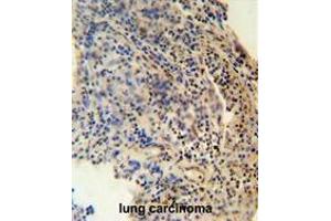 ZNF197 antibody (N-term) immunohistochemistry analysis in formalin fixed and paraffin embedded human lung carcinoma followed by peroxidase conjugation of the secondary antibody and DAB staining. (ZNF197 antibody  (N-Term))