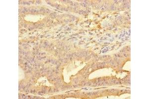 Immunohistochemistry of paraffin-embedded human endometrial cancer using ABIN7158455 at dilution of 1:100