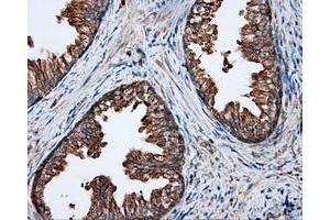 Immunohistochemical staining of paraffin-embedded Adenocarcinoma of ovary tissue using anti-RC201933 mouse monoclonal antibody. (PIM2 antibody)