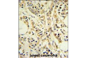 RPS13 Antibody IHC analysis in formalin fixed and paraffin embedded breast carcinoma followed by peroxidase conjugation of the secondary antibody and DAB staining.