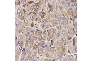Immunohistochemistry of paraffin-embedded human liver cancer using GAS2 antibody (ABIN5970514) at dilution of 1/200 (40x lens). (GAS2 antibody)