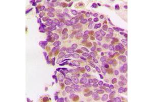 Immunohistochemical analysis of PS1D staining in human breast cancer formalin fixed paraffin embedded tissue section. (ZCCHC17 antibody  (Center))