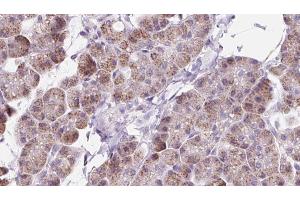 ABIN6273224 at 1/100 staining Human pancreas cancer tissue by IHC-P. (DAAM1 antibody  (Internal Region))