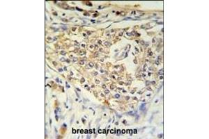 ADFP Antibody (Center) (ABIN651311 and ABIN2840181) IHC analysis in formalin fixed and paraffin embedded breast carcinoma followed by peroxidase conjugation of the secondary antibody and DAB staining. (ADRP antibody  (AA 186-214))