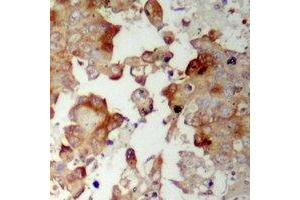 Immunohistochemical analysis of MRPS17 staining in human prostate cancer formalin fixed paraffin embedded tissue section.