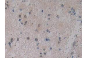 Detection of IGFBP1 in Human Glioma Tissue using Polyclonal Antibody to Insulin Like Growth Factor Binding Protein 1 (IGFBP1) (IGFBPI antibody  (AA 36-235))