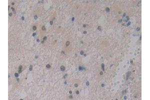 Detection of IGFBP1 in Human Glioma Tissue using Polyclonal Antibody to Insulin Like Growth Factor Binding Protein 1 (IGFBP1)