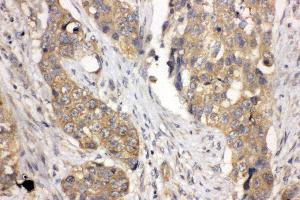 Anti-LASP1 antibody, IHC(P) IHC(P): Human Lung Cancer Tissue (LASP1 antibody  (N-Term))