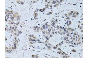 Immunohistochemistry of paraffin-embedded human liver cancer using SIN3A antibody. (SIN3A antibody)