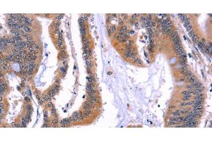 Immunohistochemistry of paraffin-embedded Human colon cancer using ARC Polyclonal Antibody at dilution of 1:50 (ARC antibody)
