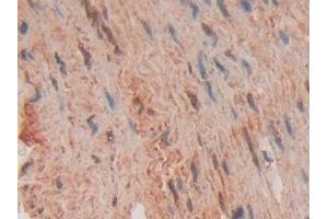 Detection of FADD in Human Stomach cancer Tissue using Polyclonal Antibody to Fas Associating Death Domain Containing Protein (FADD) (FADD antibody  (AA 12-206))