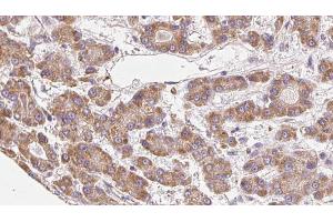 ABIN6272676 at 1/100 staining Human liver cancer tissue by IHC-P. (BAI3 antibody  (Internal Region))