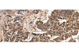 Immunohistochemistry of paraffin-embedded Human colorectal cancer tissue using GANAB Polyclonal Antibody at dilution of 1:30(x200) (GANAB antibody)