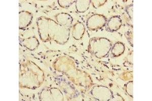 Immunohistochemistry of paraffin-embedded human gastric cancer using ABIN7145609 at dilution of 1:100 (Pallidin antibody  (AA 1-170))