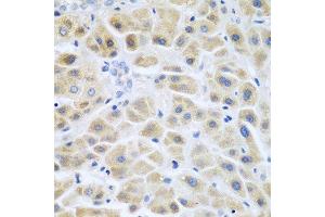 Immunohistochemistry of paraffin-embedded human liver cancer using ACCS antibody at dilution of 1:200 (40x lens). (PHACS antibody)