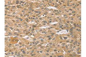 The image on the left is immunohistochemistry of paraffin-embedded Human liver cancer tissue using ABIN7192633(SPON1 Antibody) at dilution 1/30, on the right is treated with synthetic peptide. (SPON1 antibody)
