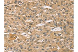 The image on the left is immunohistochemistry of paraffin-embedded Human liver cancer tissue using ABIN7192633(SPON1 Antibody) at dilution 1/30, on the right is treated with synthetic peptide.