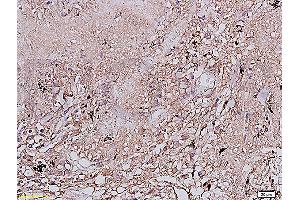 Formalin-fixed and paraffin embedded human lung carcinoma labeled with Anti-EGFR Polyclonal Antibody, Unconjugated (ABIN725720) at 1:200 followed by conjugation to the secondary antibody and DAB staining