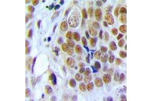 Immunohistochemical analysis of Nucleolin staining in human breast cancer formalin fixed paraffin embedded tissue section. (Nucleolin antibody)