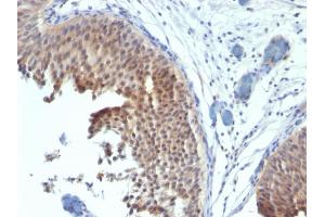 Formalin-fixed, paraffin-embedded human Bladder Carcinoma stained with Cytokeratin 6 Mouse Monoclonal Antibody (SPM269). (KRT6A/KRT6B/KRT6C (C-Term) antibody)